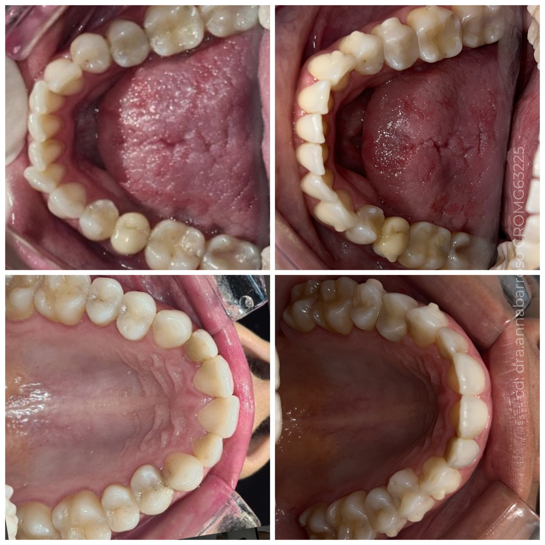 Antes e Depois 39